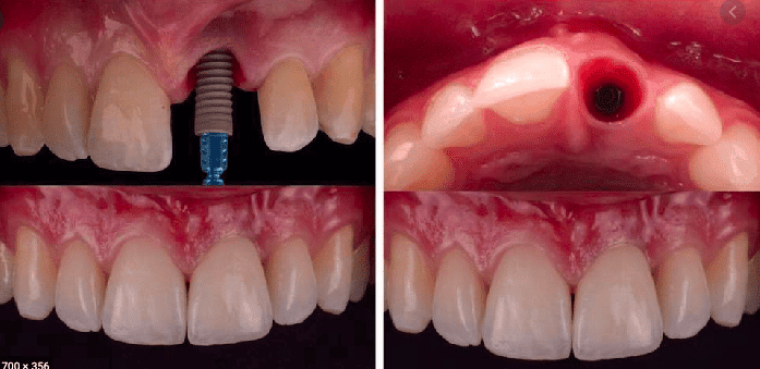 Dental Implant in Bhiwadi